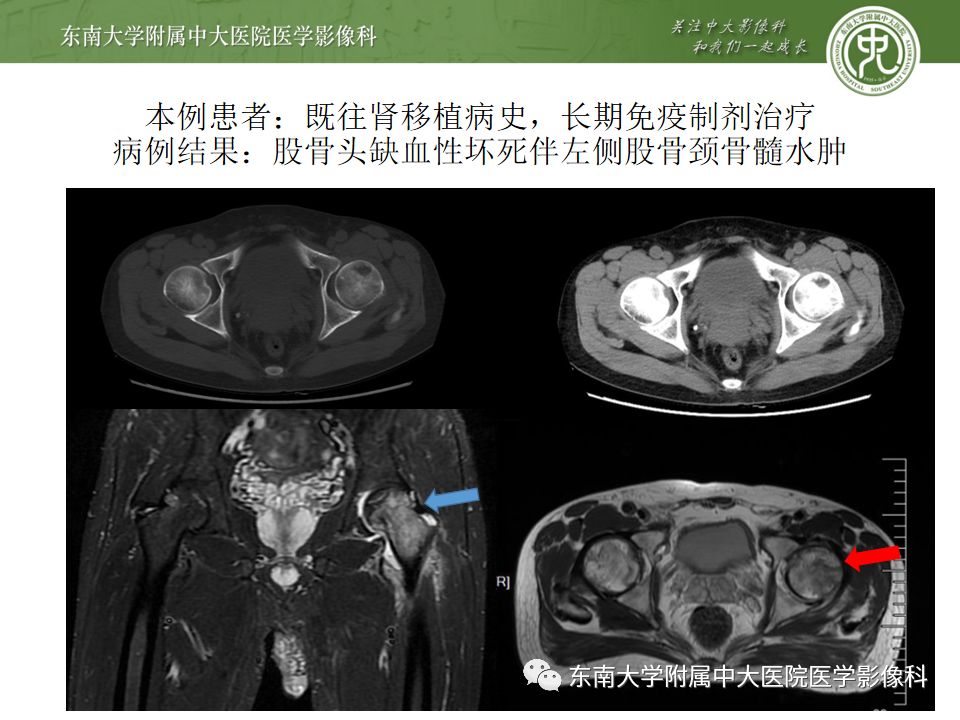 【PPT】股骨头囊性变机制及其鉴别诊断