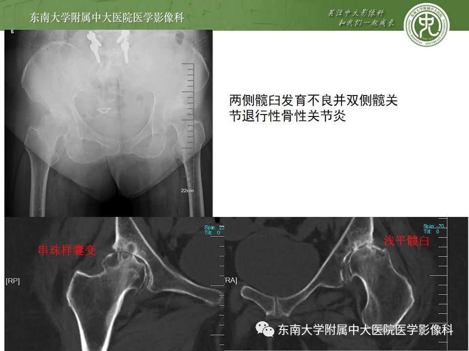 【PPT】股骨头囊性变机制及其鉴别诊断