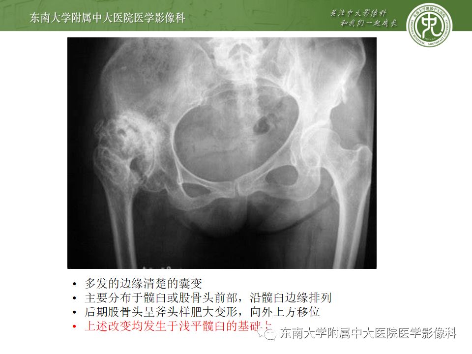 【PPT】股骨头囊性变机制及其鉴别诊断