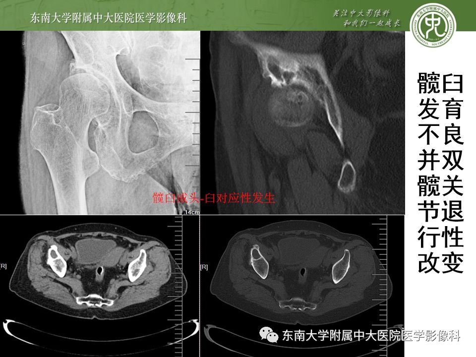 【PPT】股骨头囊性变机制及其鉴别诊断