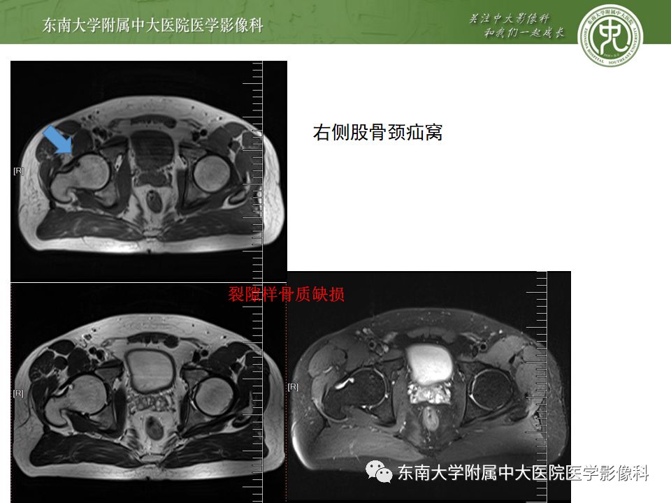 【PPT】股骨头囊性变机制及其鉴别诊断