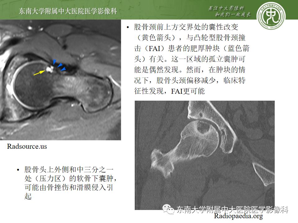 【PPT】股骨头囊性变机制及其鉴别诊断