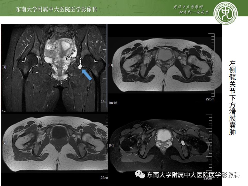 【PPT】股骨头囊性变机制及其鉴别诊断