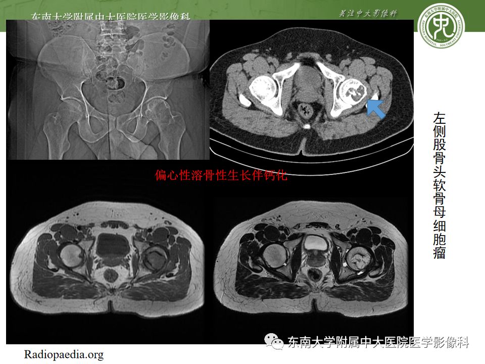 【PPT】股骨头囊性变机制及其鉴别诊断