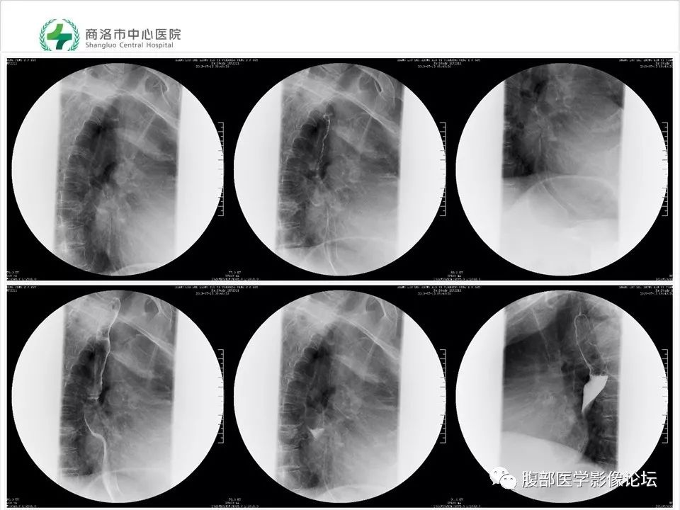 【病例】胃部胃肠道间质瘤1例X线CT影像