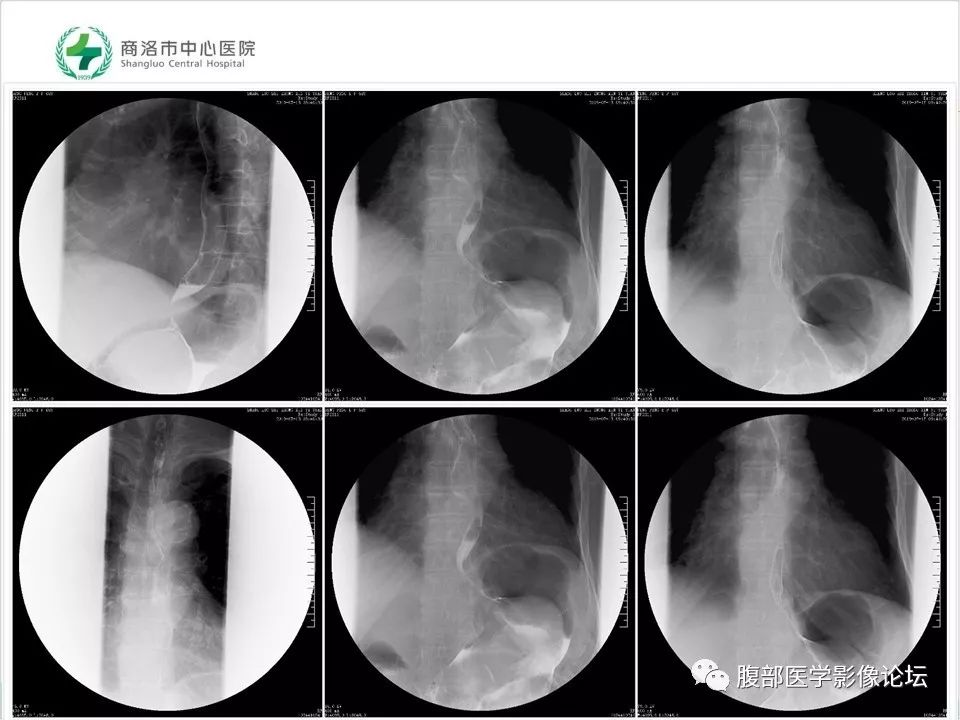 【病例】胃部胃肠道间质瘤1例X线CT影像