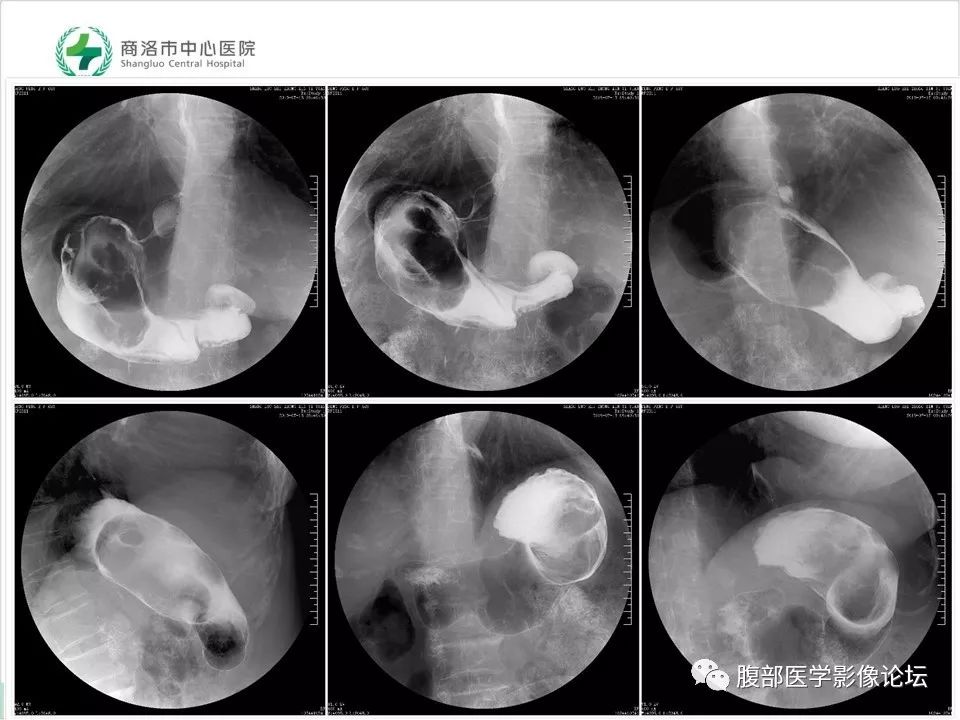 【病例】胃部胃肠道间质瘤1例X线CT影像