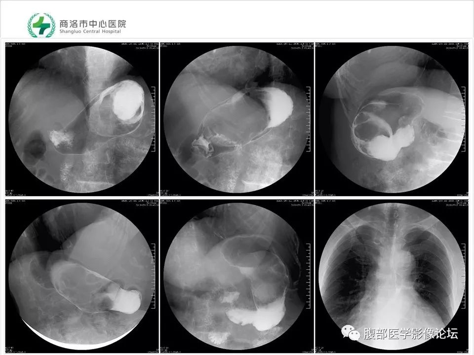 【病例】胃部胃肠道间质瘤1例X线CT影像