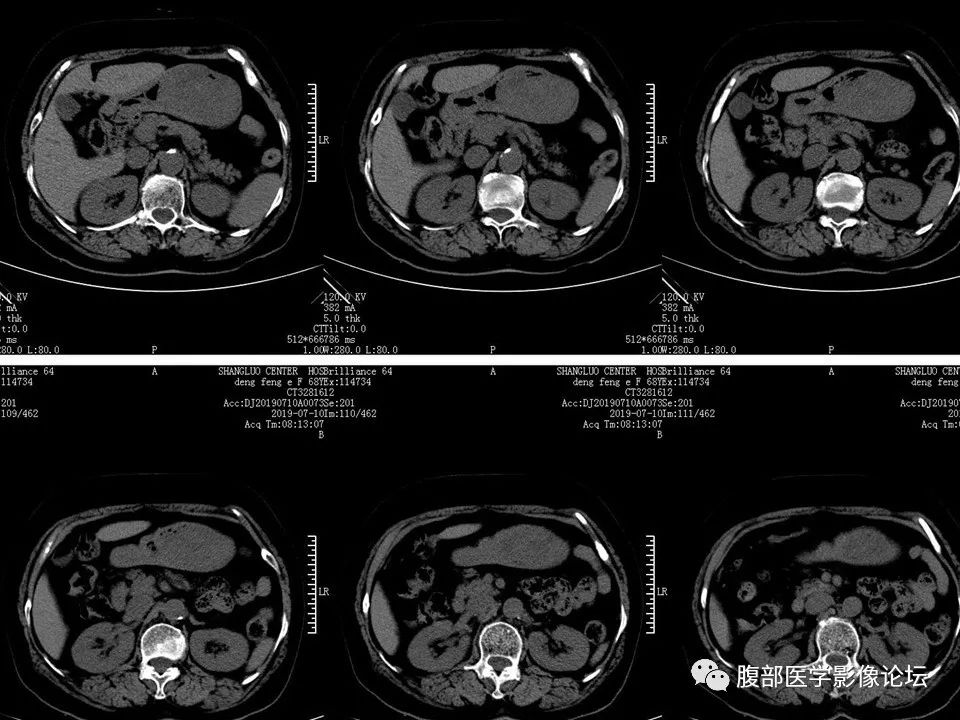 【病例】胃部胃肠道间质瘤1例X线CT影像