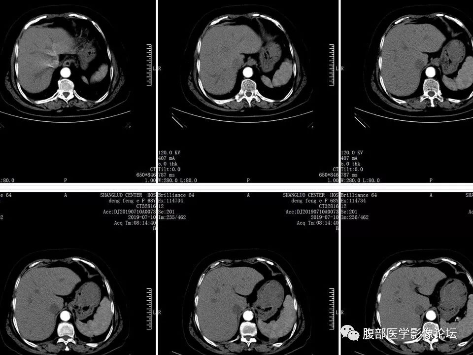 【病例】胃部胃肠道间质瘤1例X线CT影像