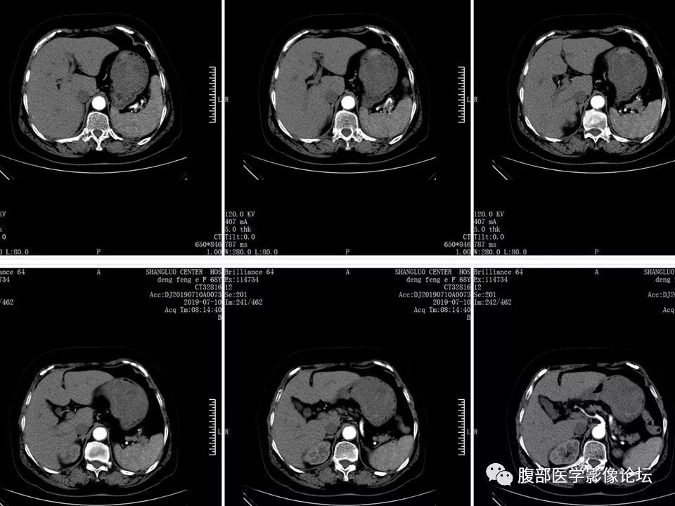 【病例】胃部胃肠道间质瘤1例X线CT影像