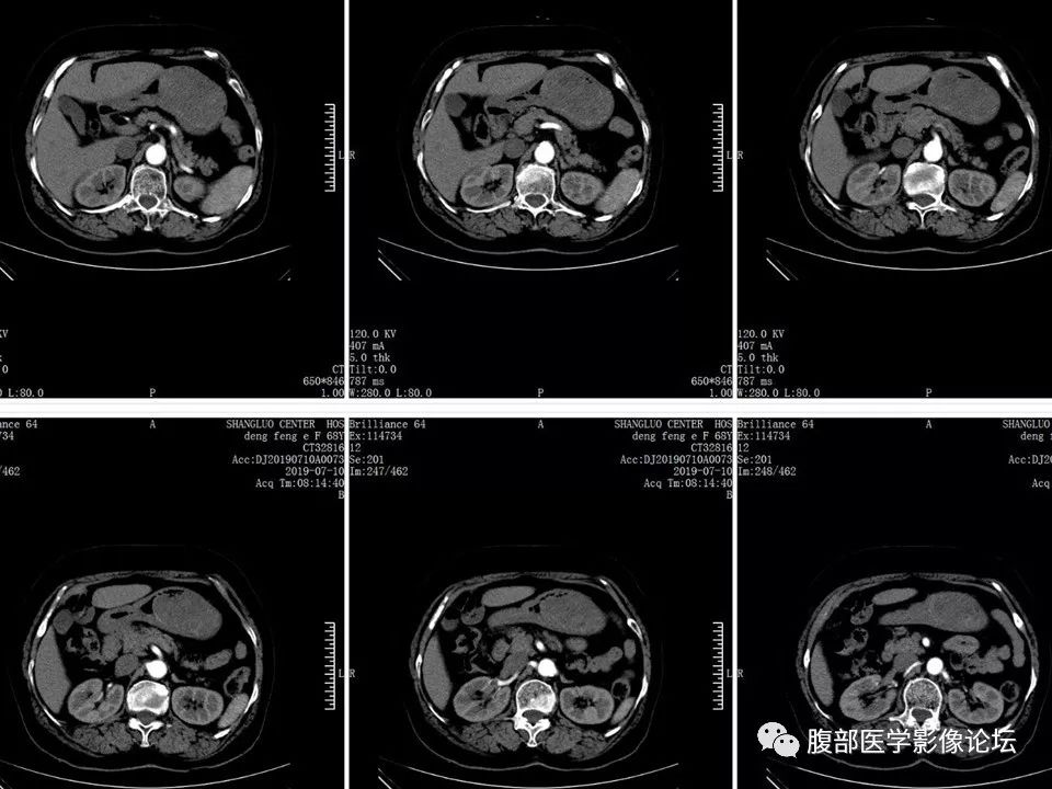【病例】胃部胃肠道间质瘤1例X线CT影像