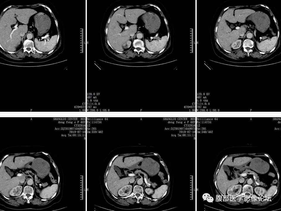 【病例】胃部胃肠道间质瘤1例X线CT影像