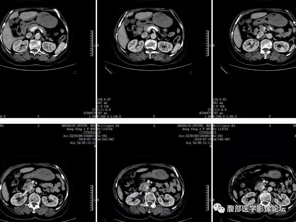 【病例】胃部胃肠道间质瘤1例X线CT影像
