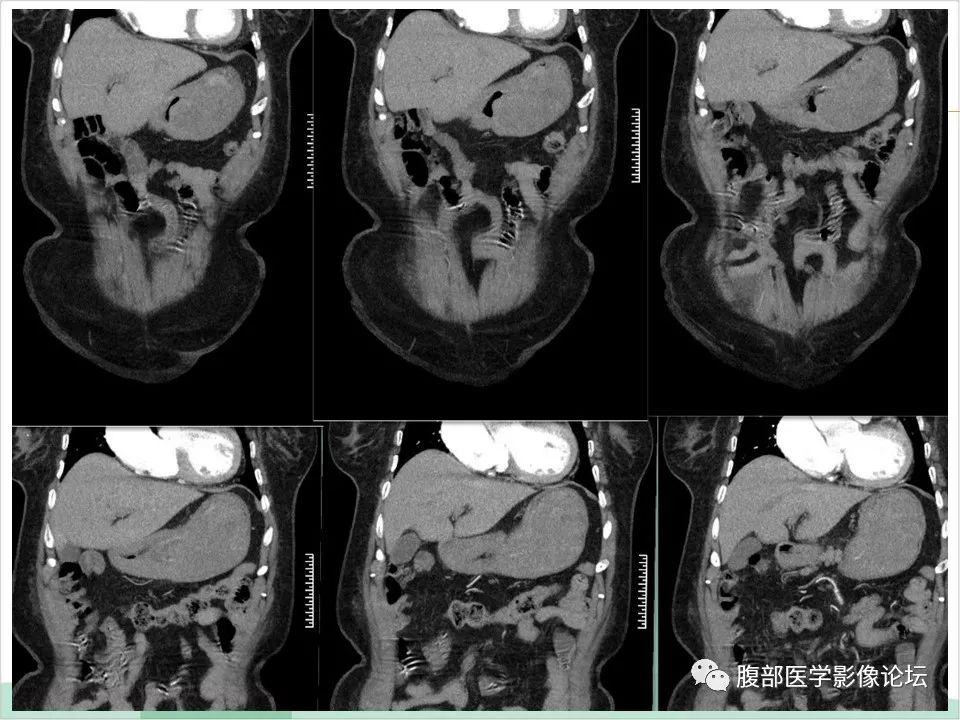 【病例】胃部胃肠道间质瘤1例X线CT影像