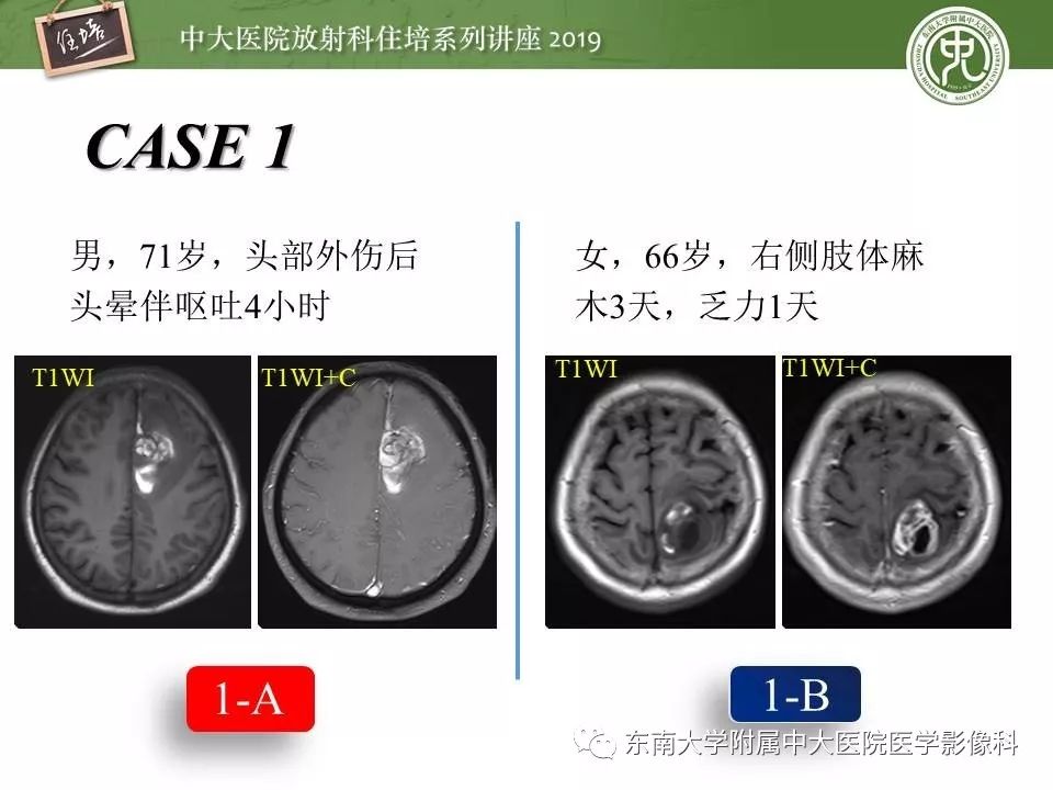 【PPT】脑肿瘤影像诊断思路