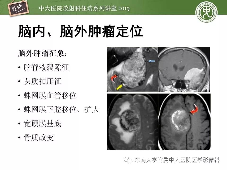 【PPT】脑肿瘤影像诊断思路