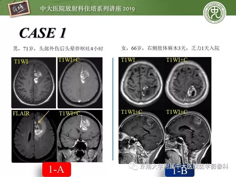 【PPT】脑肿瘤影像诊断思路