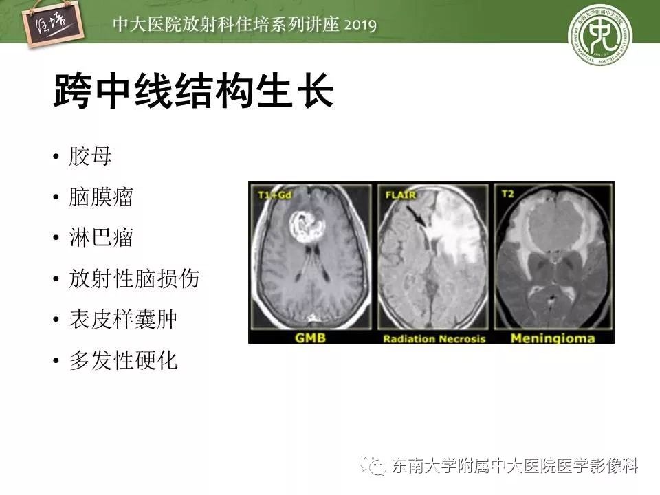 【PPT】脑肿瘤影像诊断思路