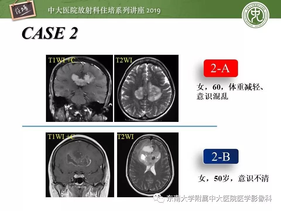 【PPT】脑肿瘤影像诊断思路