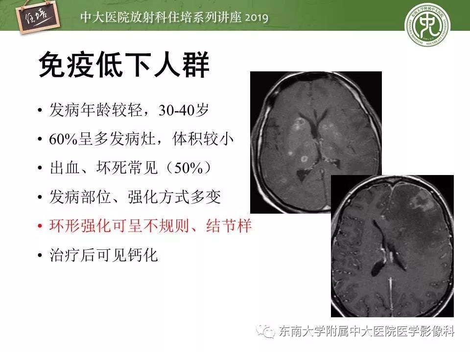 【PPT】脑肿瘤影像诊断思路