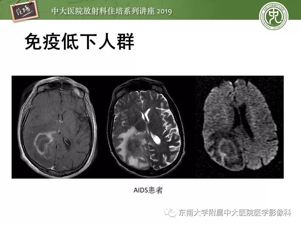 【PPT】脑肿瘤影像诊断思路