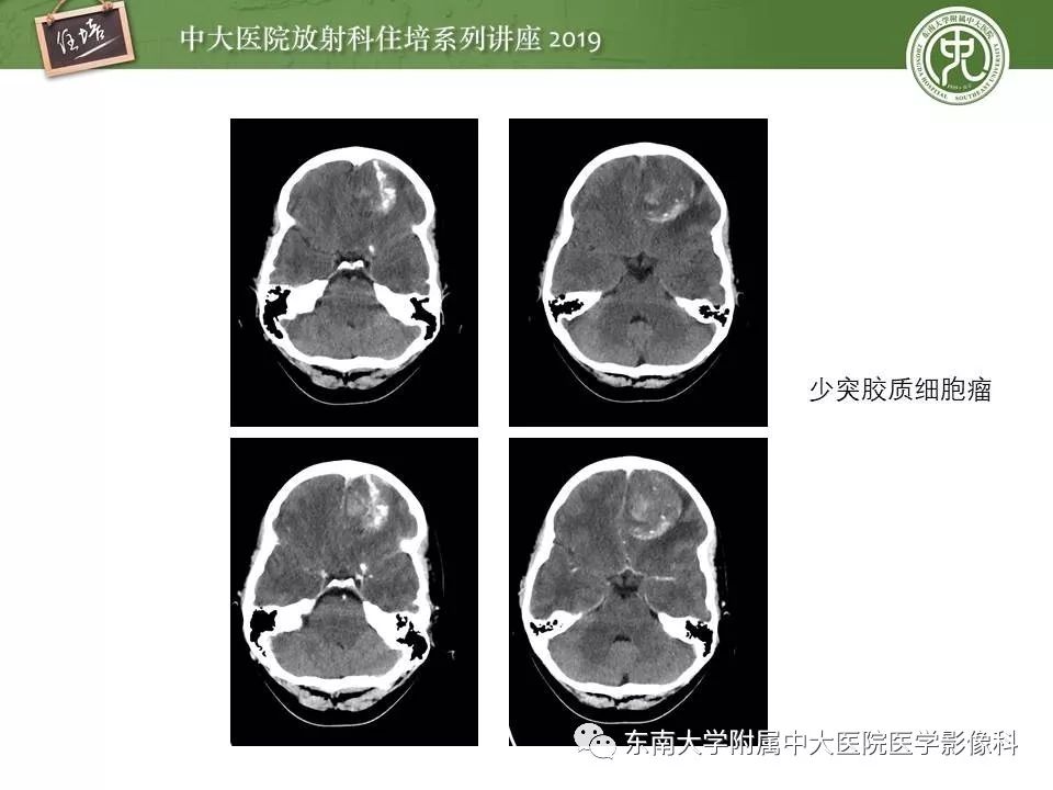 【PPT】脑肿瘤影像诊断思路