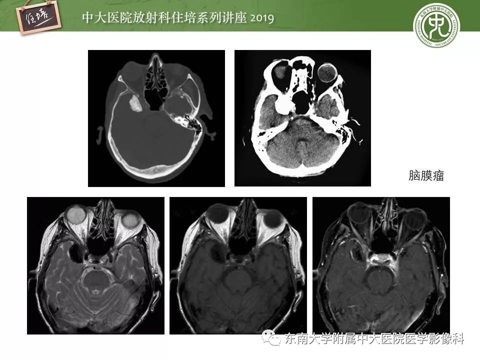 【PPT】脑肿瘤影像诊断思路
