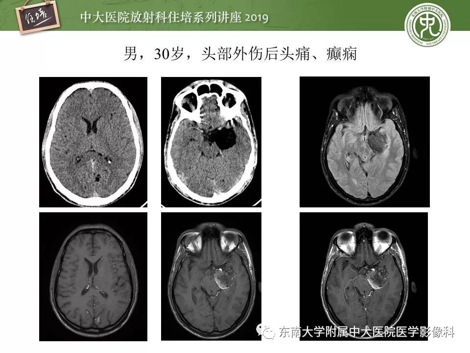 【PPT】脑肿瘤影像诊断思路