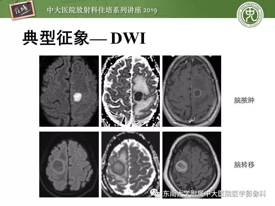 【PPT】脑肿瘤影像诊断思路