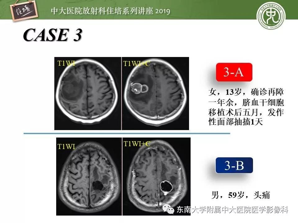 【PPT】脑肿瘤影像诊断思路