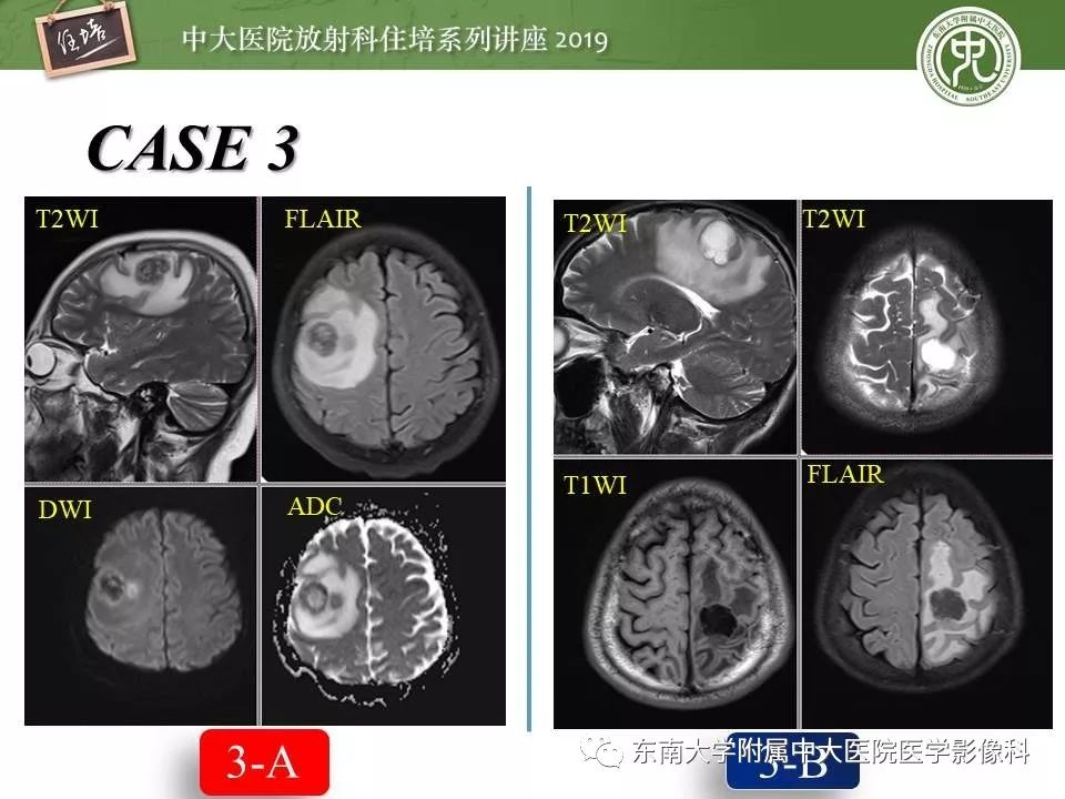 【PPT】脑肿瘤影像诊断思路