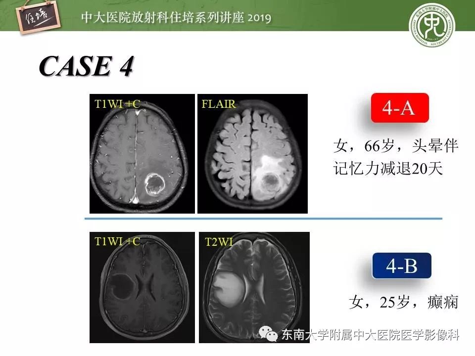 【PPT】脑肿瘤影像诊断思路