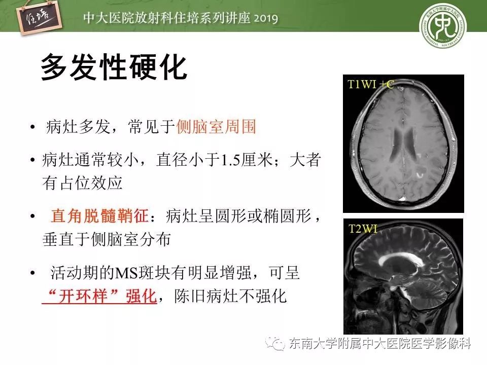 【PPT】脑肿瘤影像诊断思路