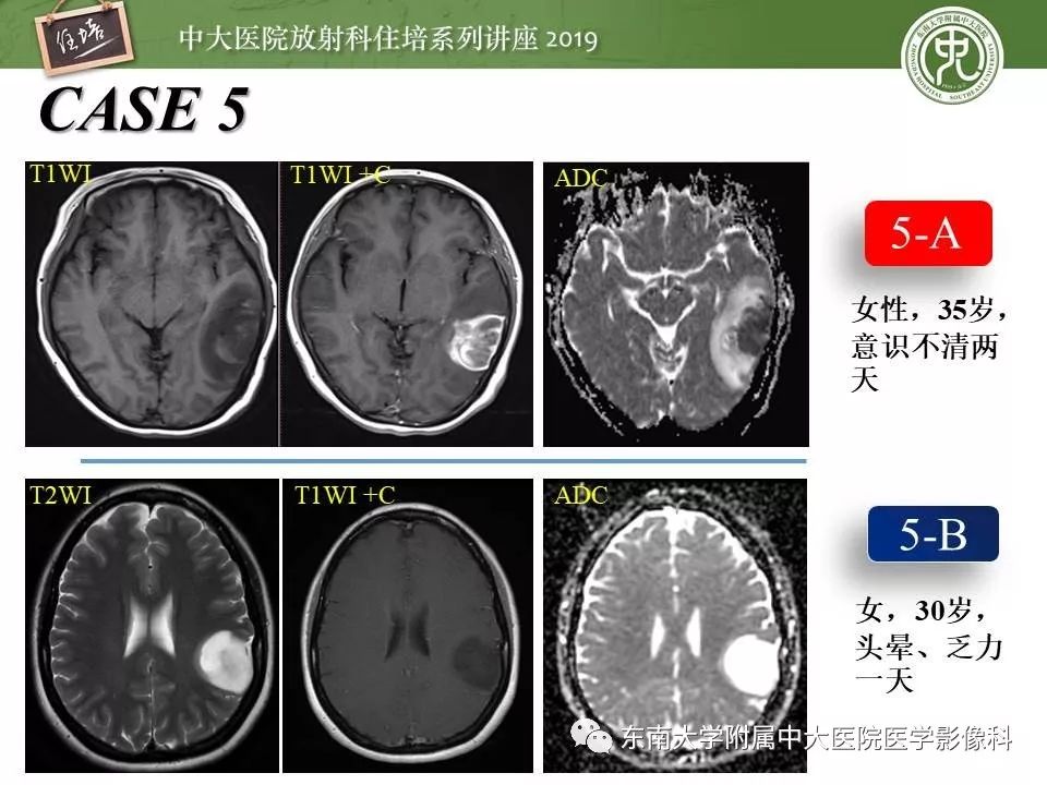【PPT】脑肿瘤影像诊断思路