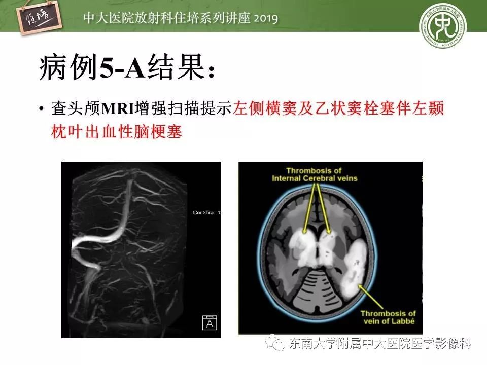 【PPT】脑肿瘤影像诊断思路