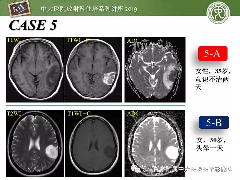 【PPT】脑肿瘤影像诊断思路