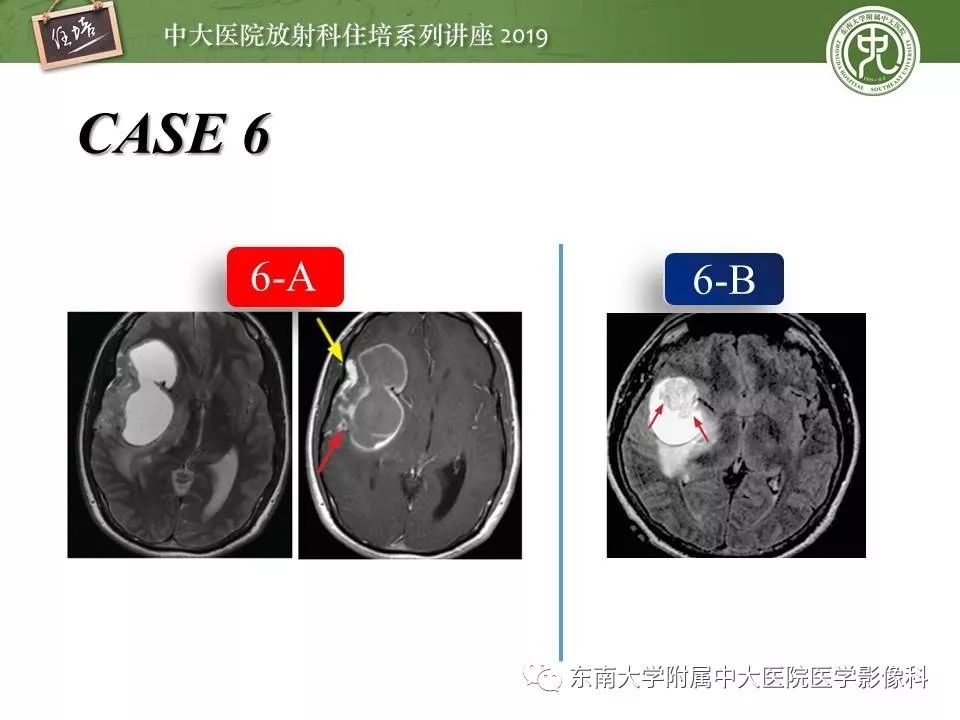 【PPT】脑肿瘤影像诊断思路