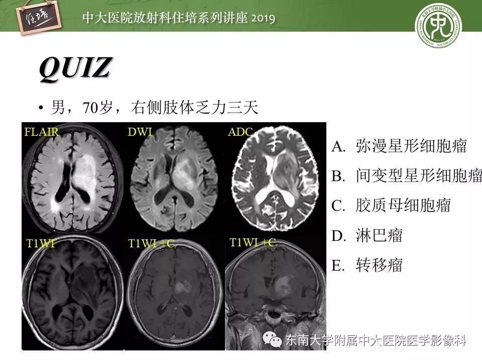 【PPT】脑肿瘤影像诊断思路