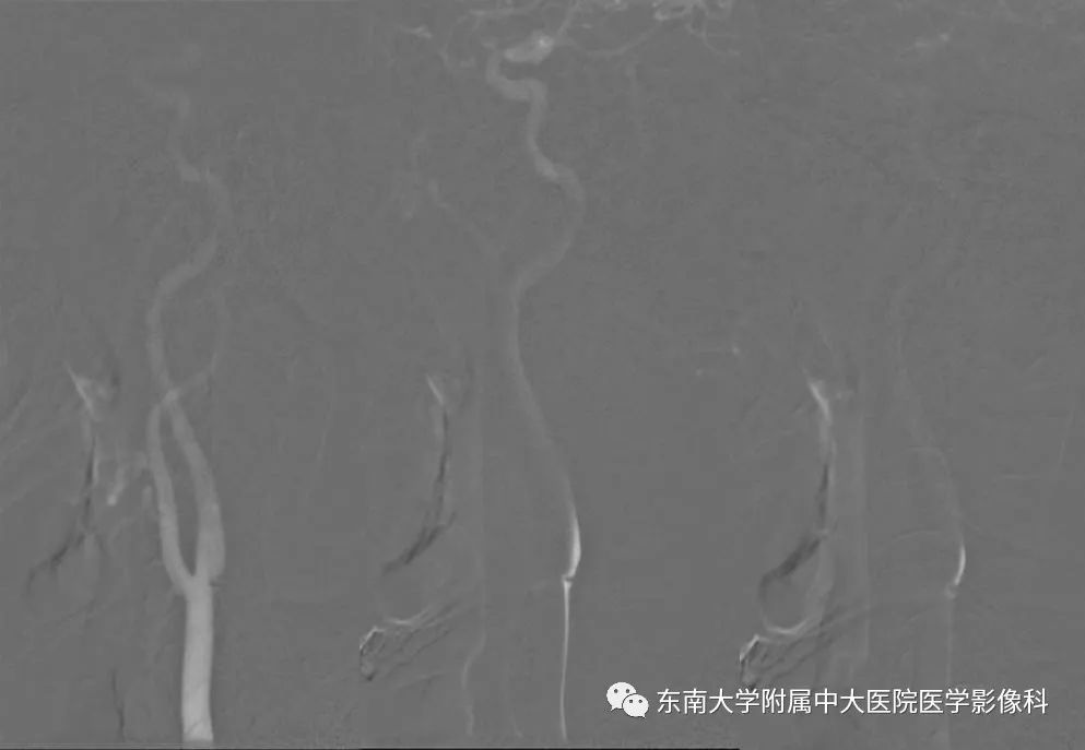 【PPT】颈动脉蹼