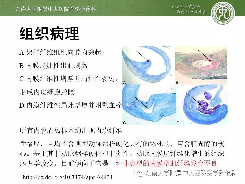 【PPT】颈动脉蹼