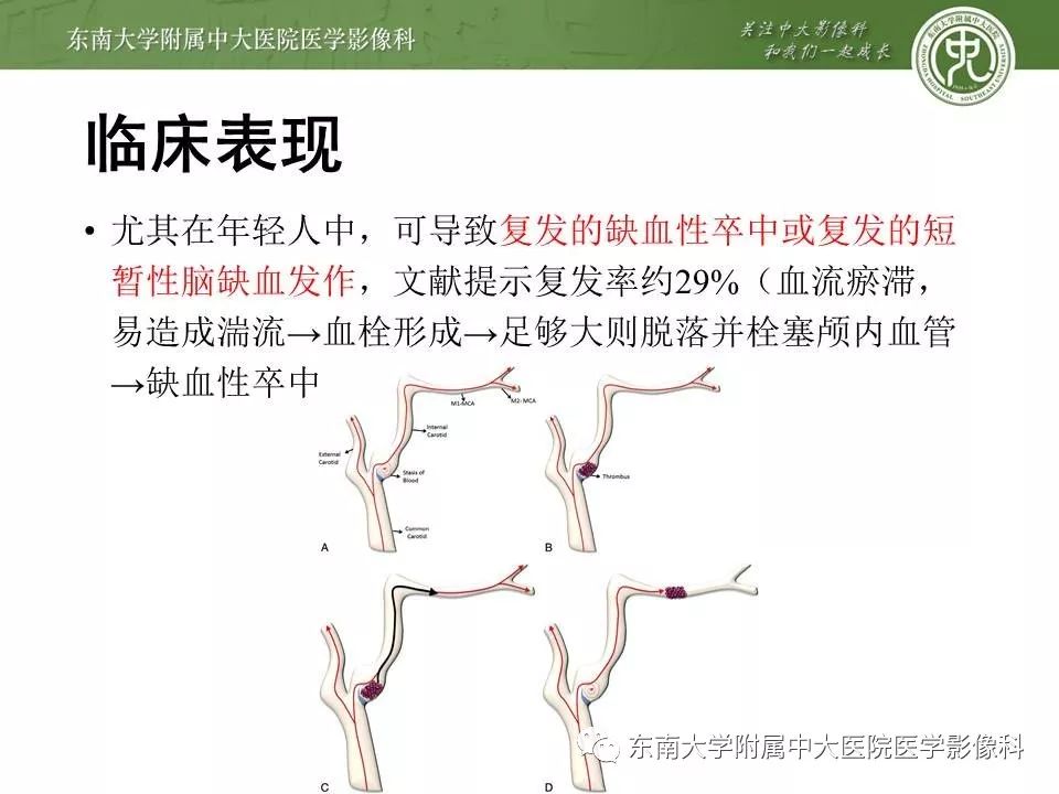 【PPT】颈动脉蹼