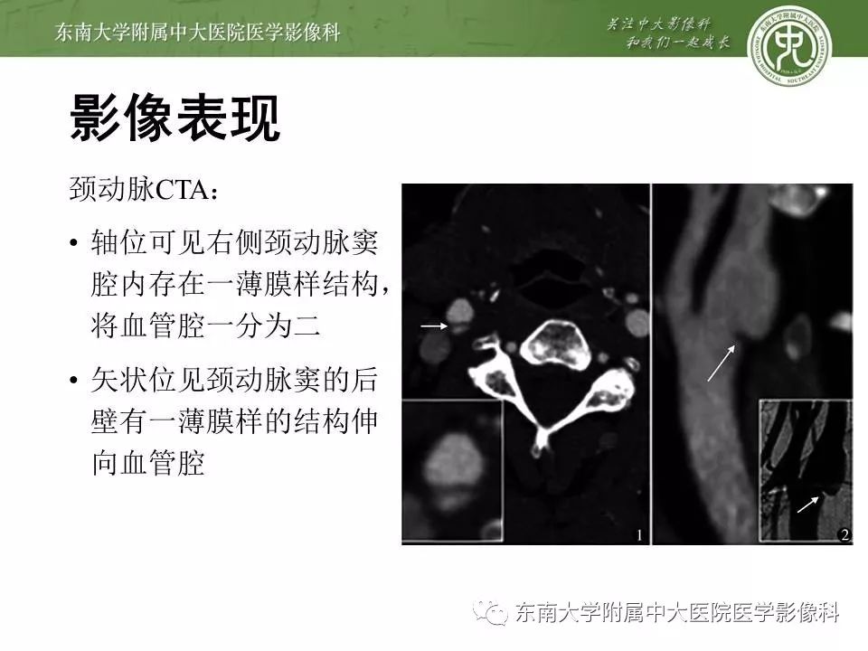 【PPT】颈动脉蹼
