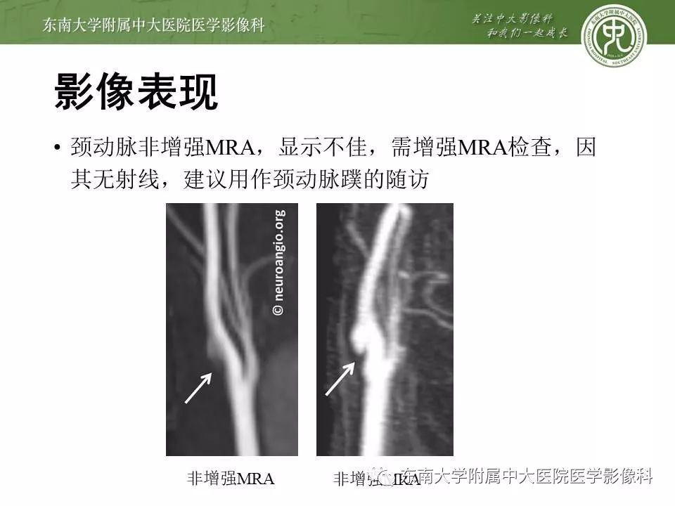 【PPT】颈动脉蹼