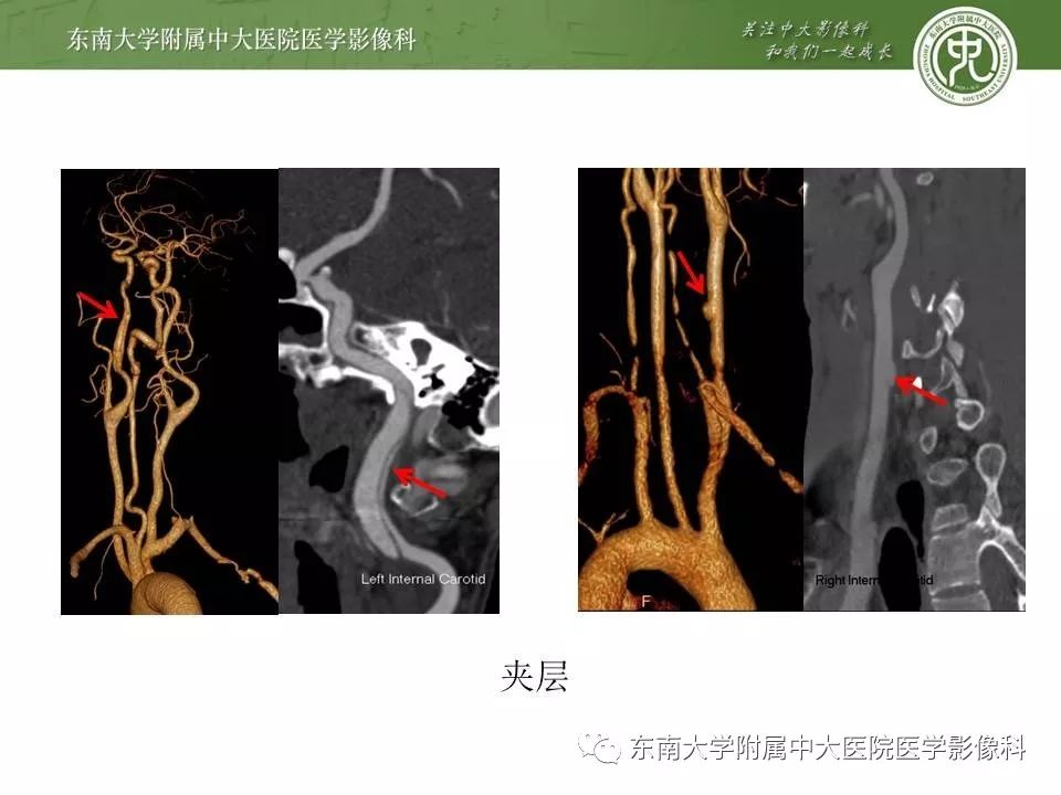 【PPT】颈动脉蹼