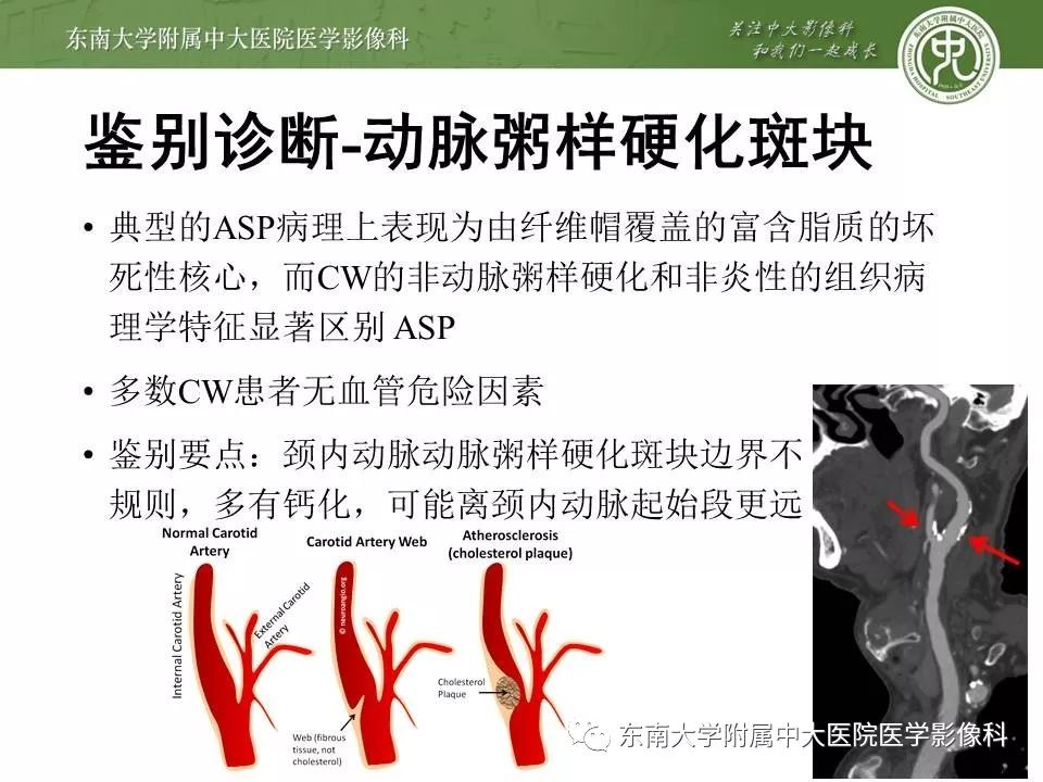 【PPT】颈动脉蹼