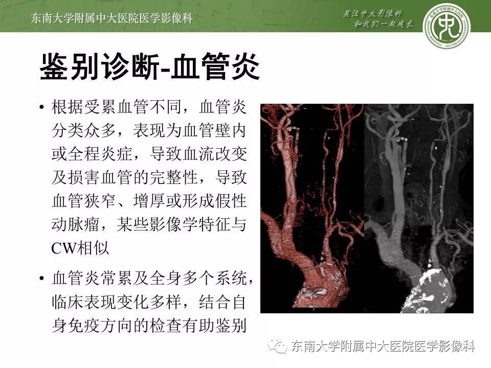 【PPT】颈动脉蹼