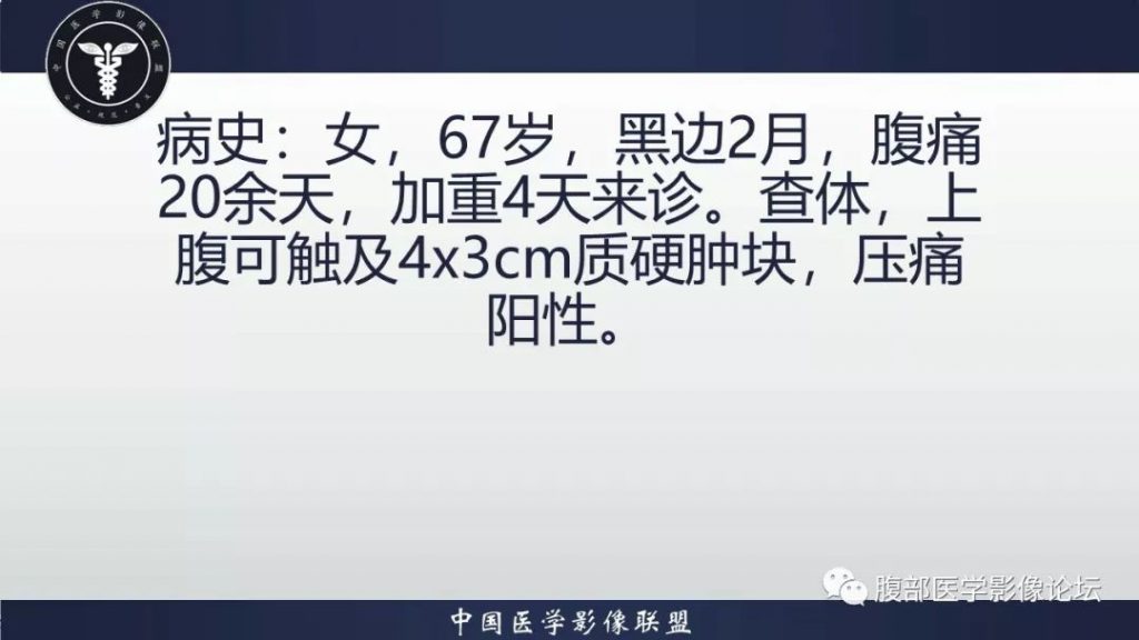 【病例】小肠间质瘤1例CT影像