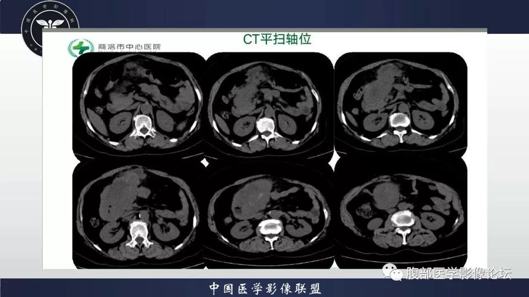 【病例】小肠间质瘤1例CT影像