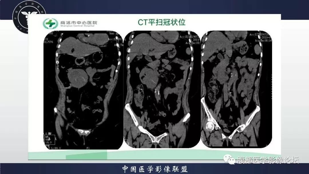 【病例】小肠间质瘤1例CT影像